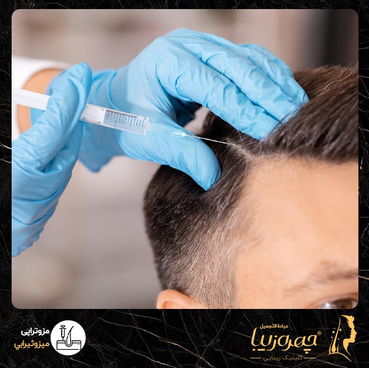 مزوتراپی مو در کلینیک چهره زیبا